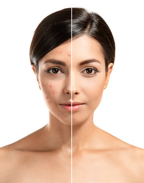 Before and after photos of acne treatment