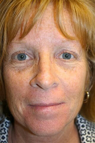 Laser Skin Resurfacing Before Photo