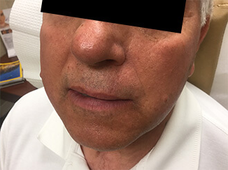 MOHS Treatment After Photo