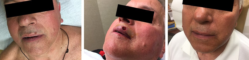 mohs-1 Before and After Mohs Surgery