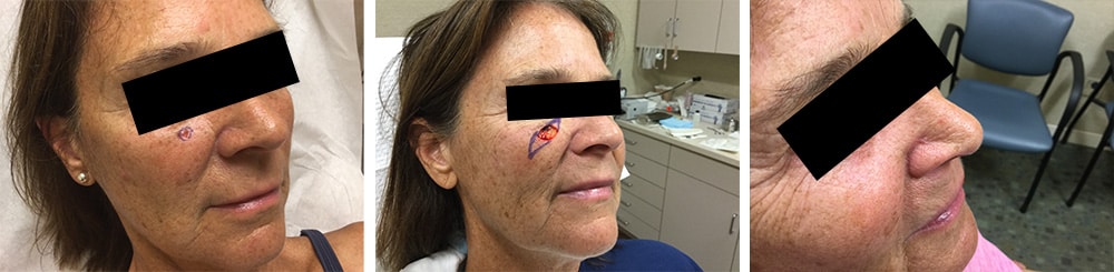 mohs-2-1 Female Before and After Mohs Surgery