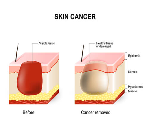 Before and after picture of skin cancer