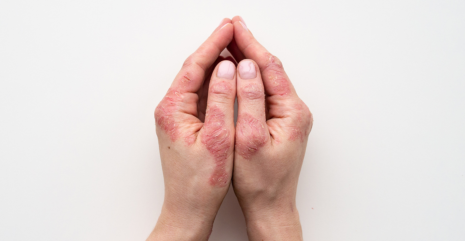 Psoriasis in woman's hands