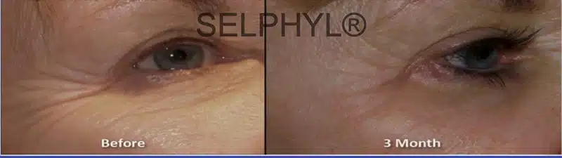 PRP Facial Rejuvenation Before and After