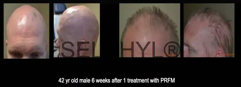 PRP Hair Restoration Before and After