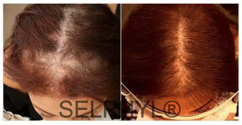 PRP Hair Restoration Before and After
