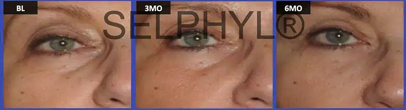 PRP Facial Rejuvenation Before and After