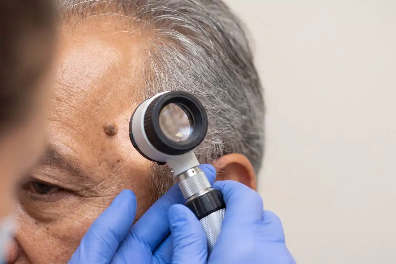 dermatologist dermoscopy mole check Dermatologist examining mole on senior man's forehead with dermatoscope